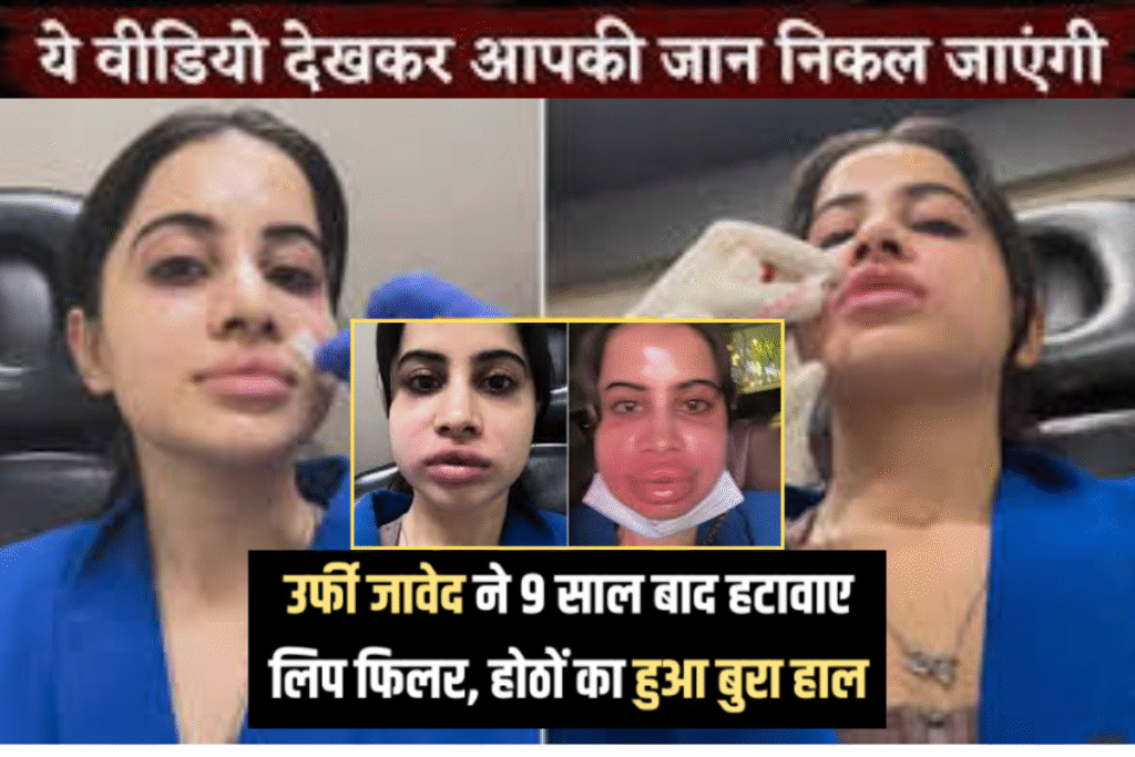 urfi javed, lip filler removal, cosmetic surgery, bigg boss ott, viral video, no filter reality, urfi transformation, beauty risks, honest review, celebrity confessions, lip filler gone wrong, urfi javed instagram, urfi before after, painful treatment, natural beauty trend, cosmetic procedure risks, celebrity beauty secrets, urfi latest news, trending now, bold and real, plastic surgery trends, beauty influencers, social media viral, urfi javed reaction, bigg boss ott contestant उर्फी जावेद ने अपने लिप फिलर हटाने का दर्दनाक वीडियो शेयर किया। जानें क्यों कहा – "यह कोई फिल्टर नहीं, फिलर्स गलत जगह लगे थे!" #CelebNews #BeautyTreatment